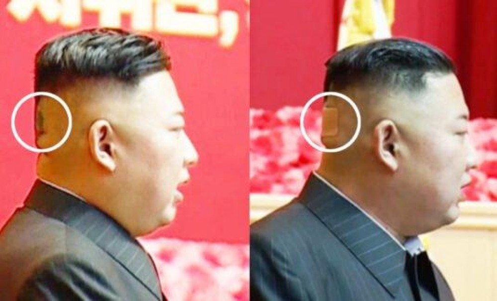 Bandajul apărut pe ceafa lui Kim Jong-un alimentează speculațiile privind problemele de sănătate ale liderului nord-coreean